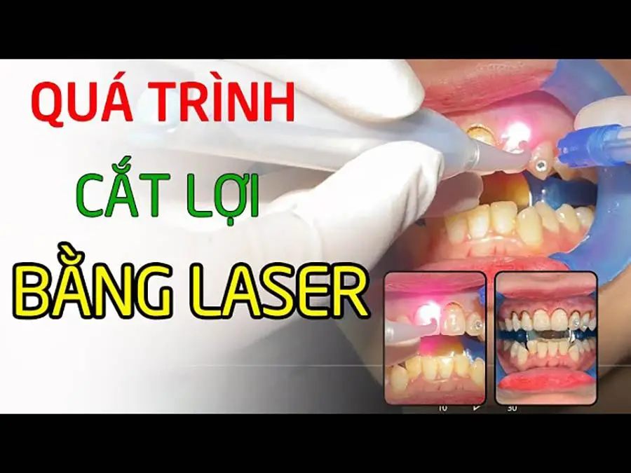 Chữa cười hở lợi bằng laser - Công nghệ cắt lợi hiệu quả