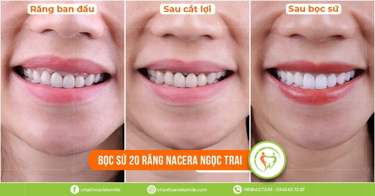  khắc phục cười hở lợi