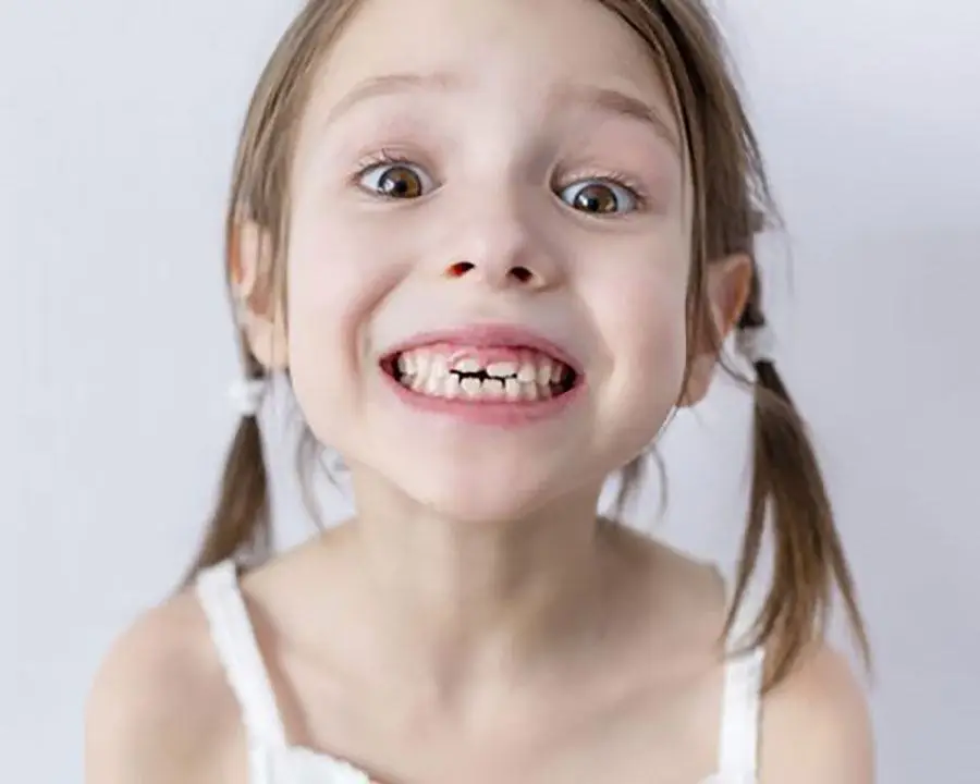 Bé cười hở lợi có ảnh hưởng sức khỏe không