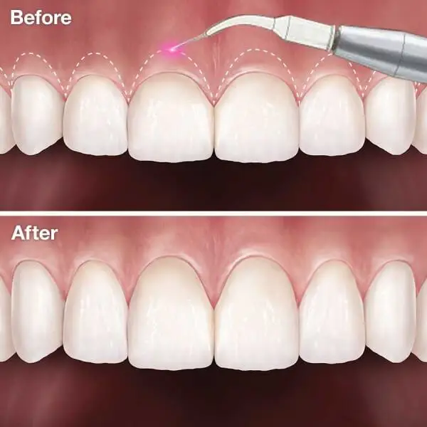 Cắt nướu đau không?