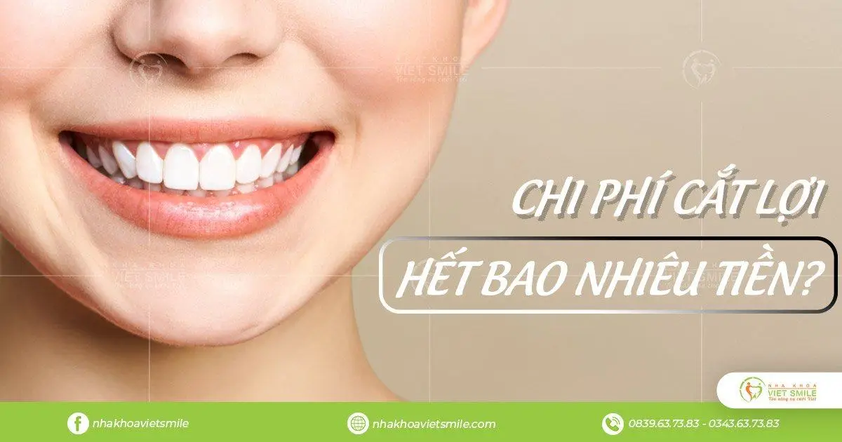 Chi phí cắt lợi hết bao nhiêu tiền