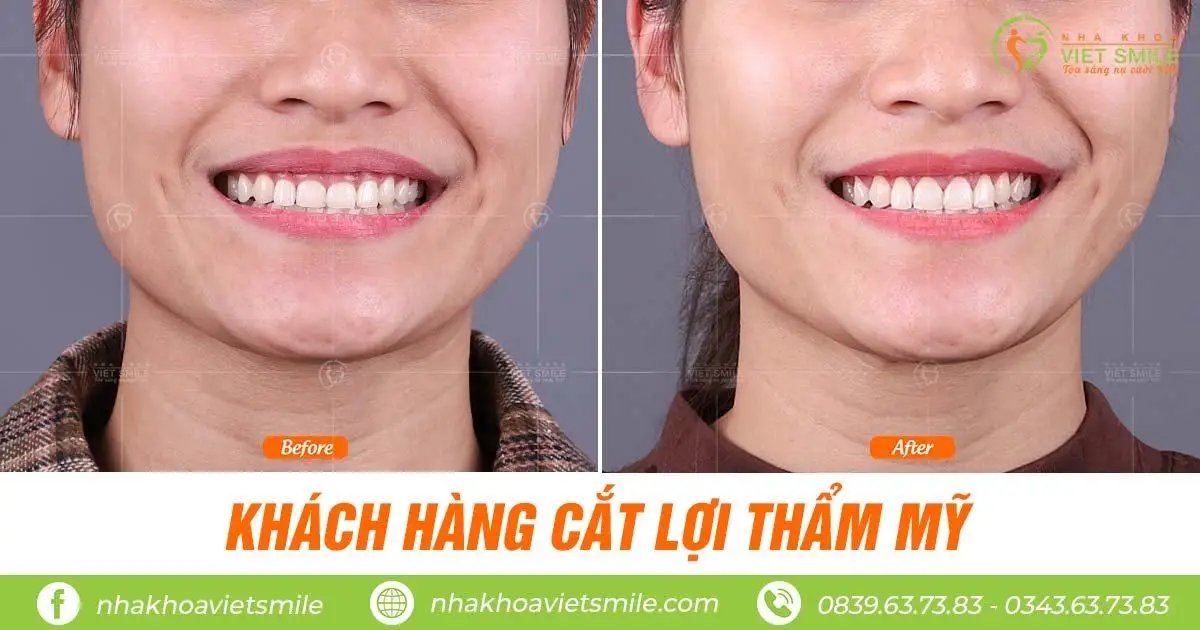 dieu tri cuoi ho loi