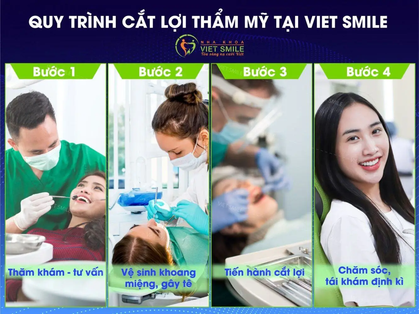Quy trình cắt lợi tại VIET SMILE