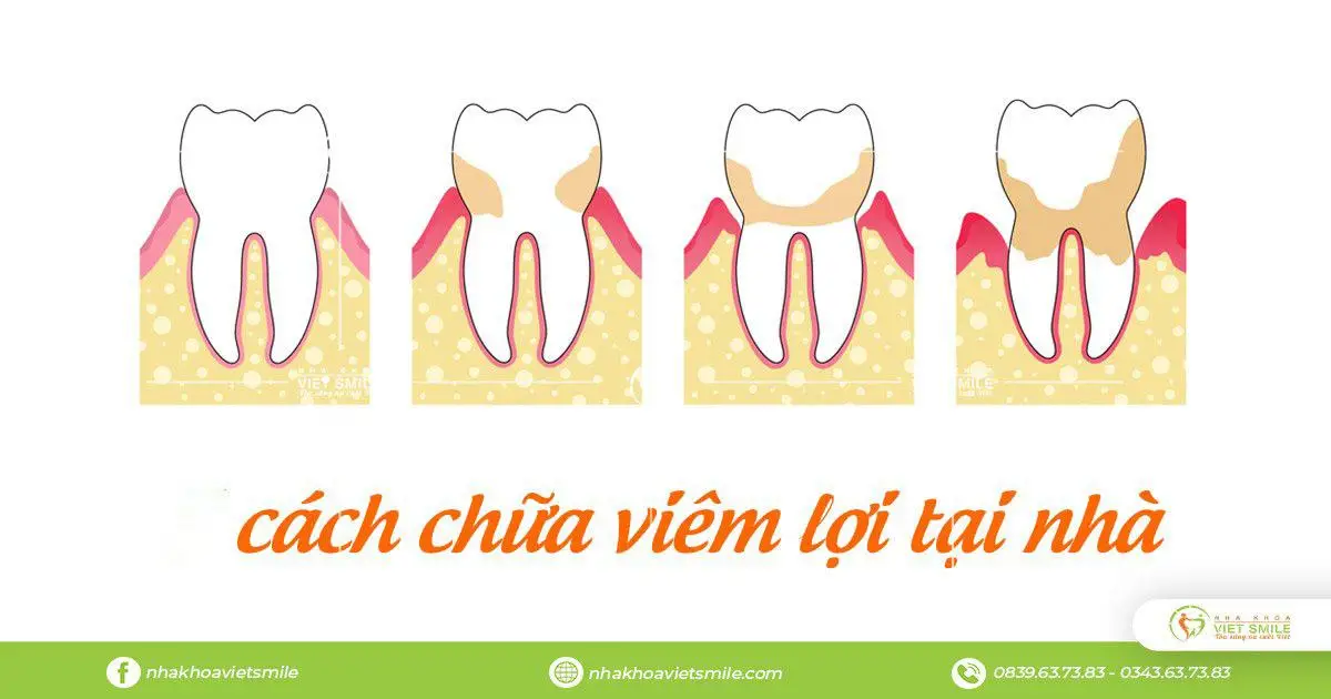 Cách chữa viêm lợi tại nhà nhanh nhất
