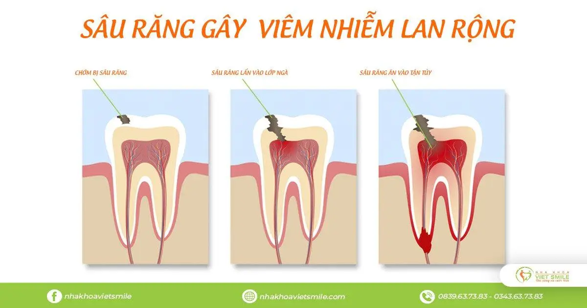 sâu răng viêm tủy