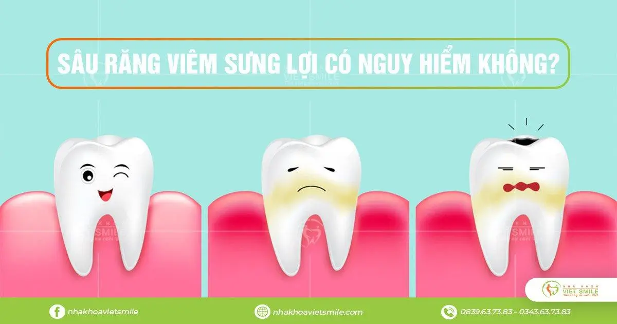 Sâu răng viêm sưng lợi 