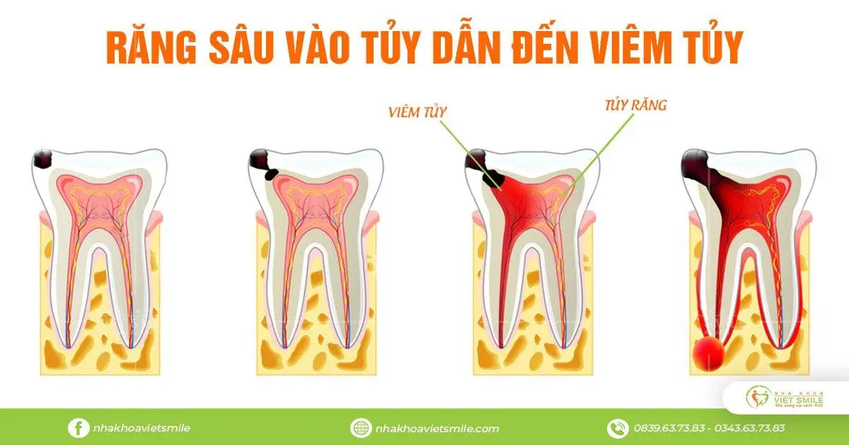 viêm tủy răng