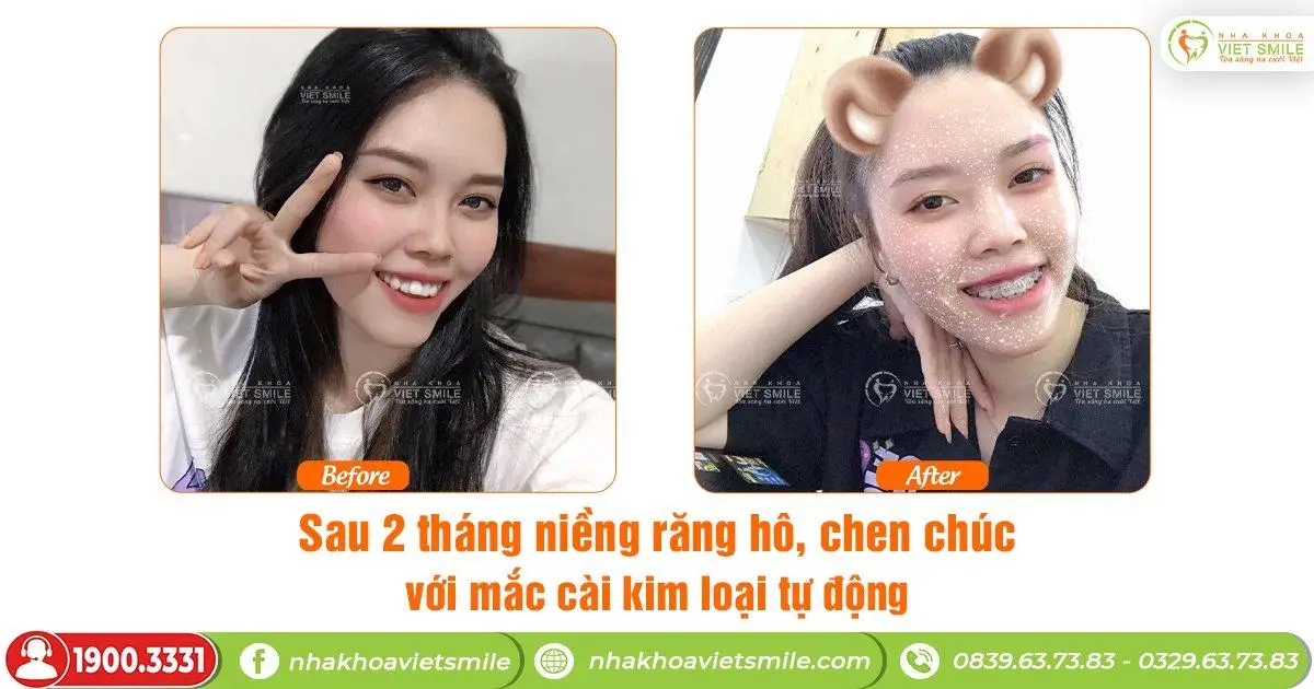 Niềng răng hô với mắc cài tự buộc sau 2 tháng