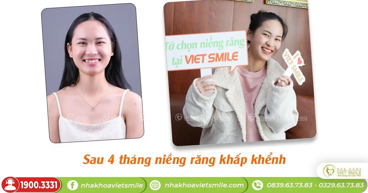 4 điều cần biết để niềng răng hiệu quả nhất