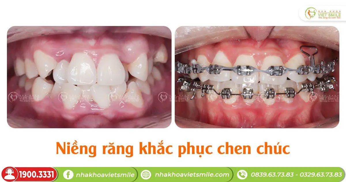 Chỉnh răng chen chúc với mắc cài kim loại