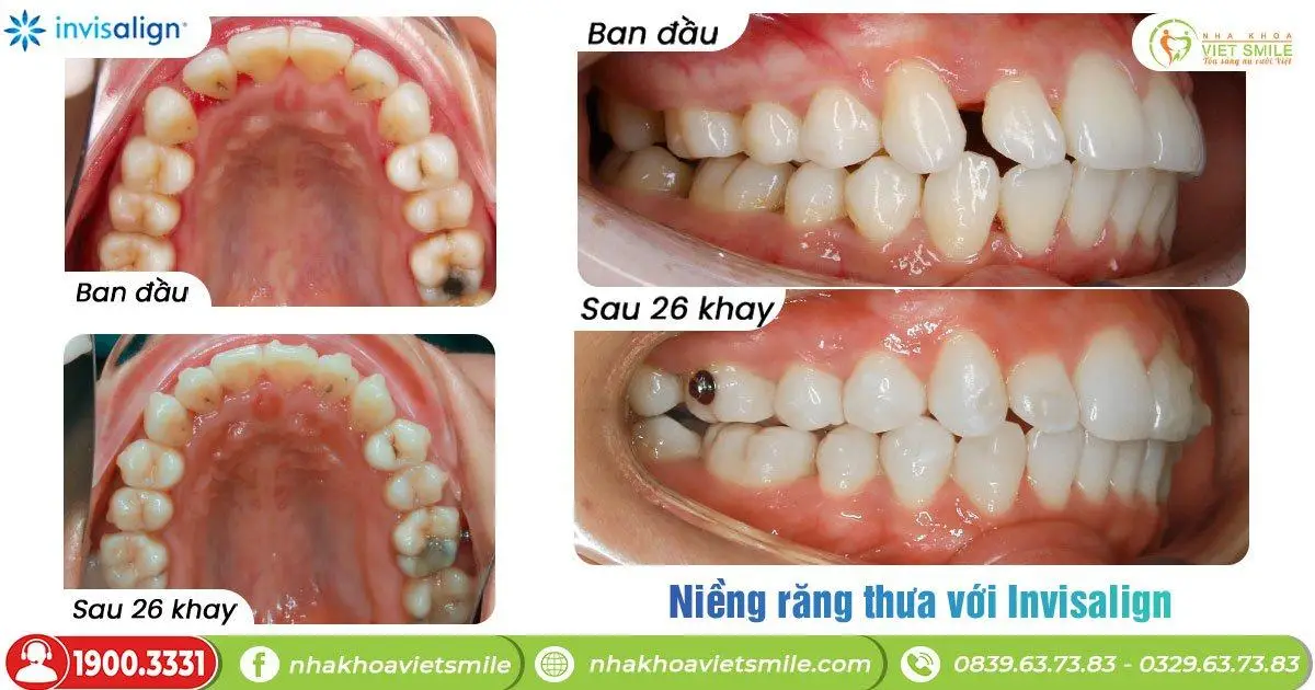 Khắc phục răng thưa với invisalign