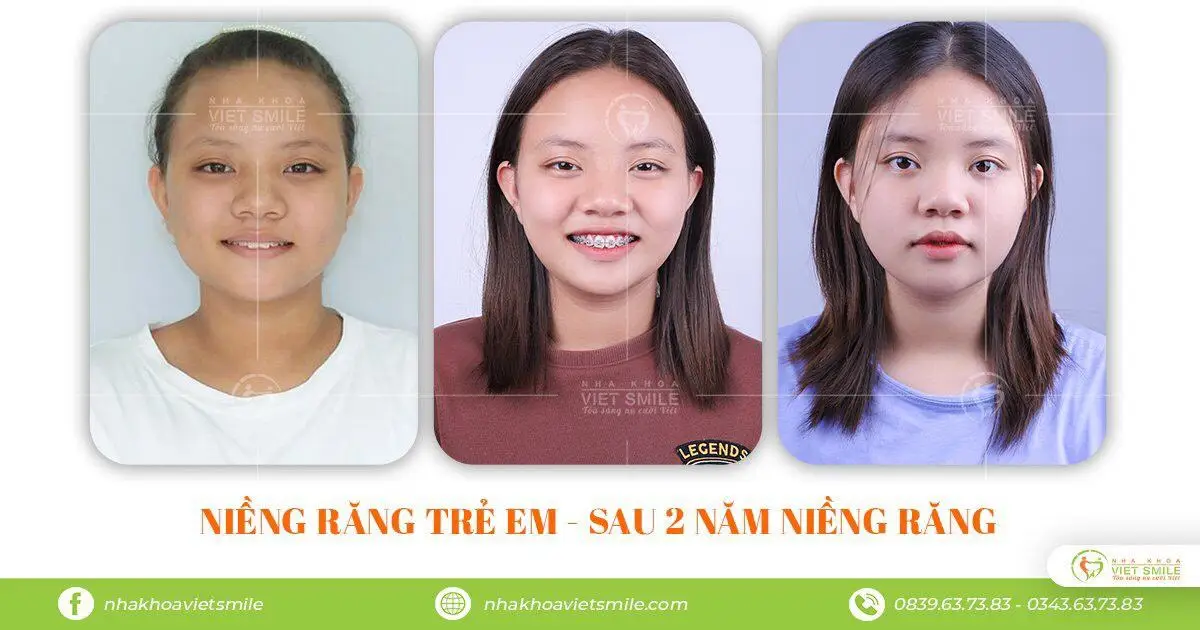Khách hàng nhí niềng răng sau 2 năm niềng