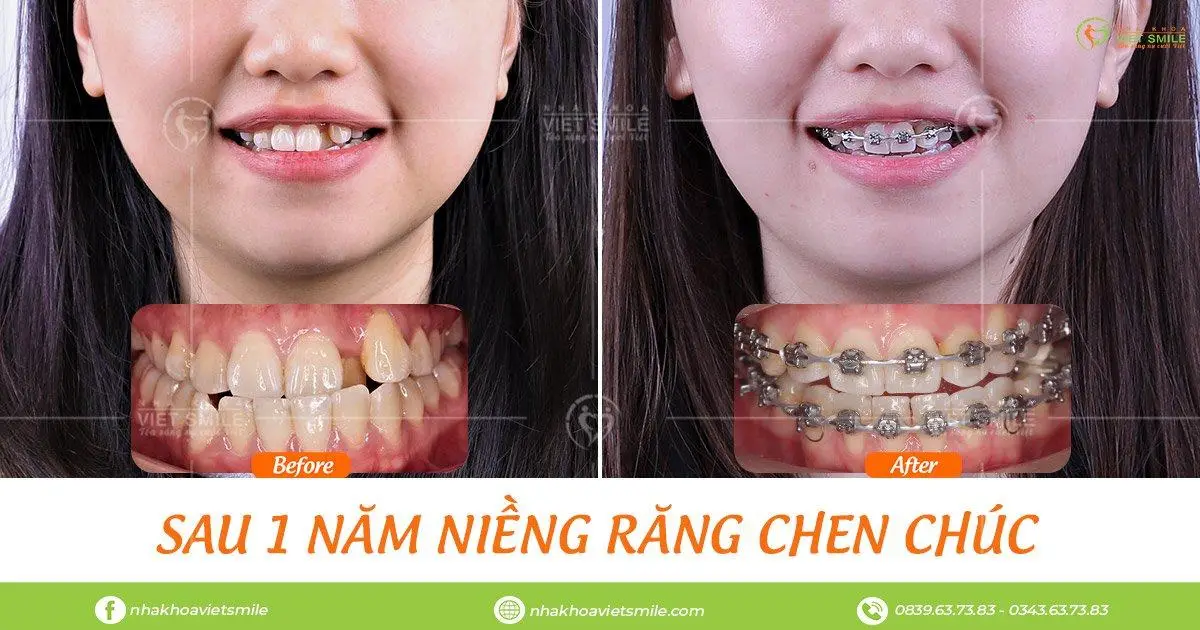 Review niềng răng trả góp uy tín