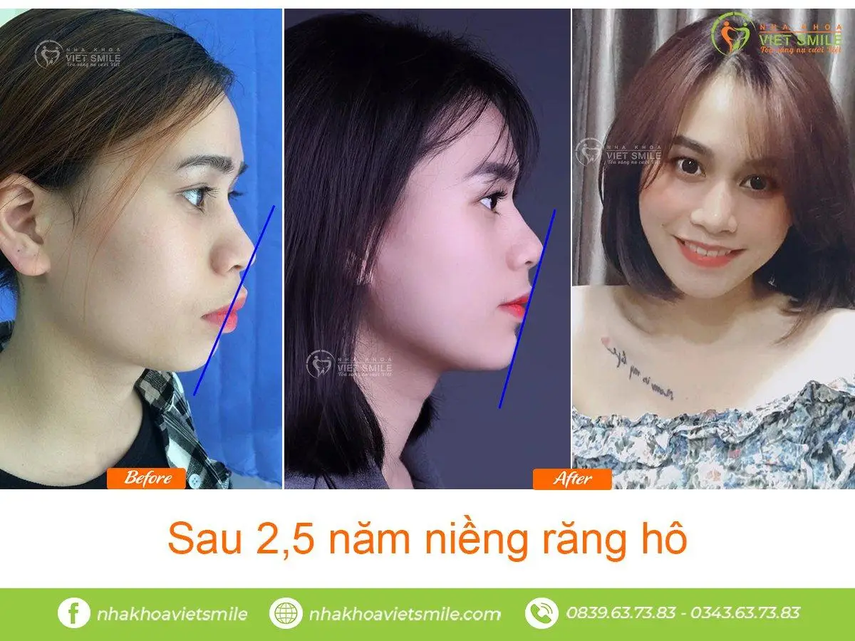 niềng răng Việt Smile