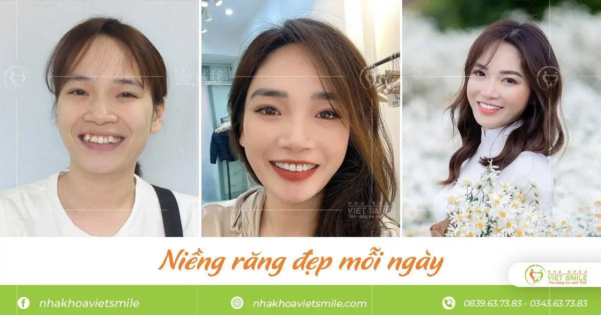 Niềng pha lê trả góp đảm bảo uy tín