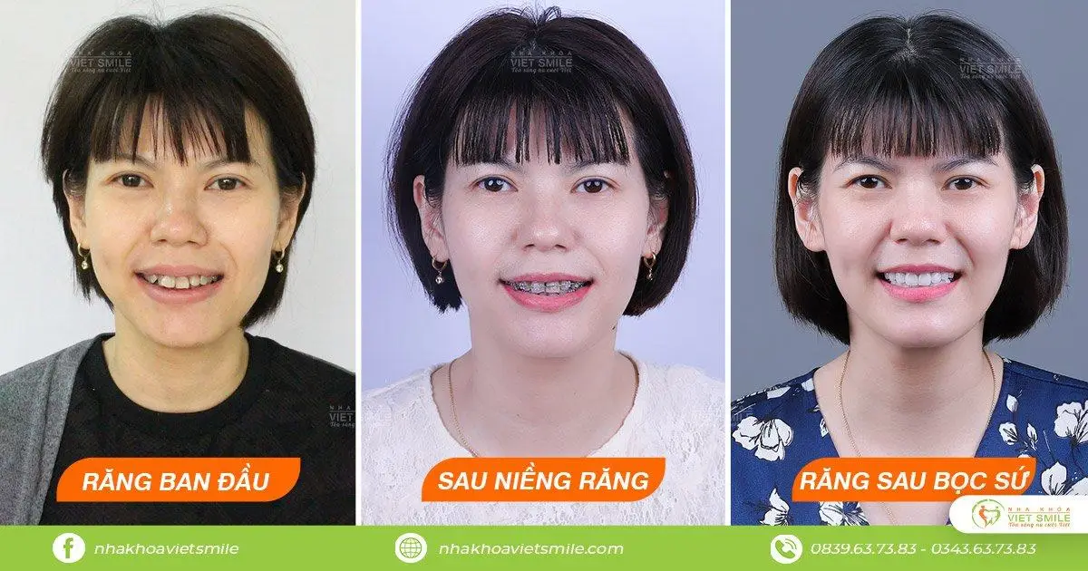 Nắn chỉnh răng hô 