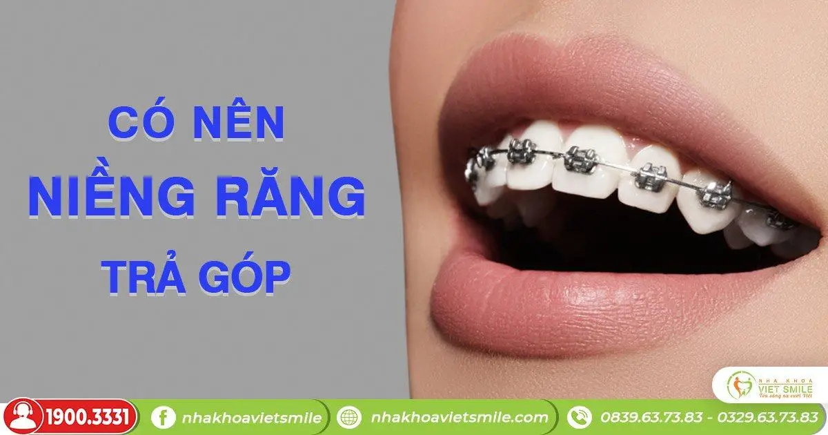 Có nên niềng răng trả góp không?