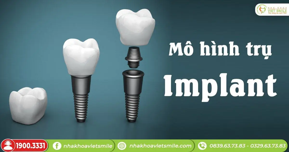 mo hinh tru implant