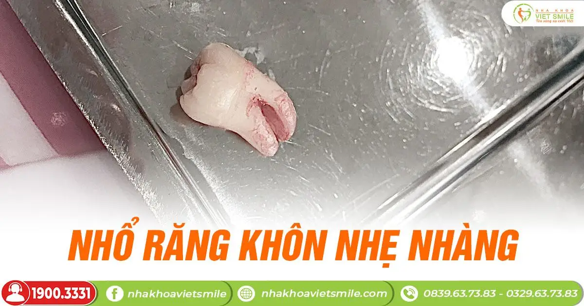 Bé răng khôn bay trong vòng 1 nốt nhạc