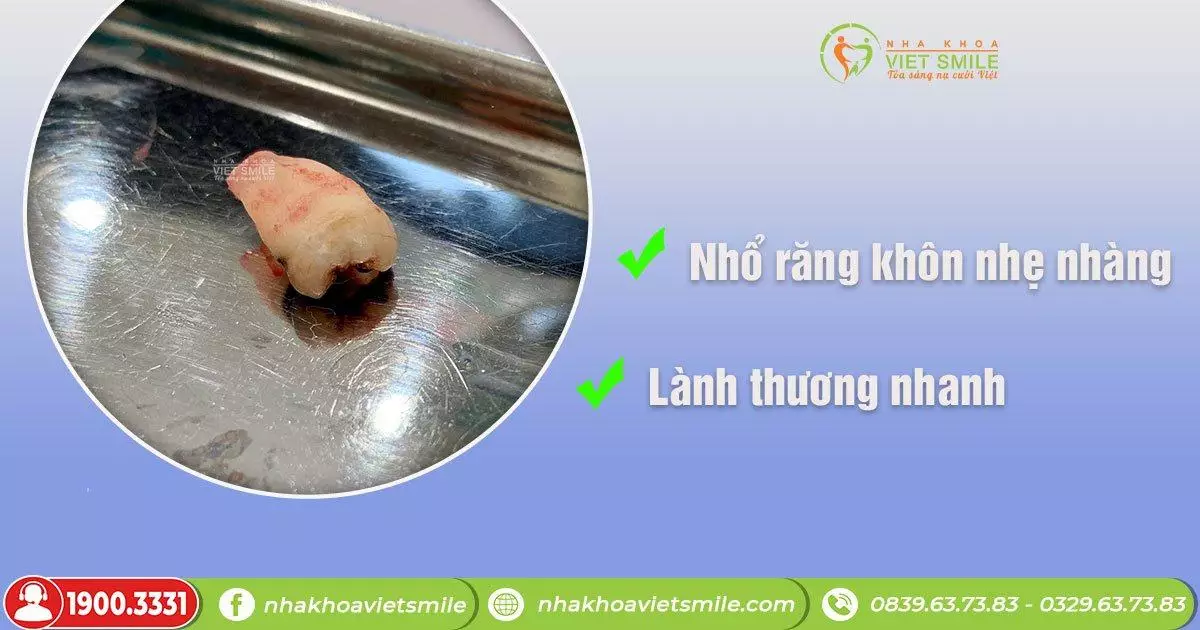 Hình ảnh chiếc răng khôn mọc lệch 