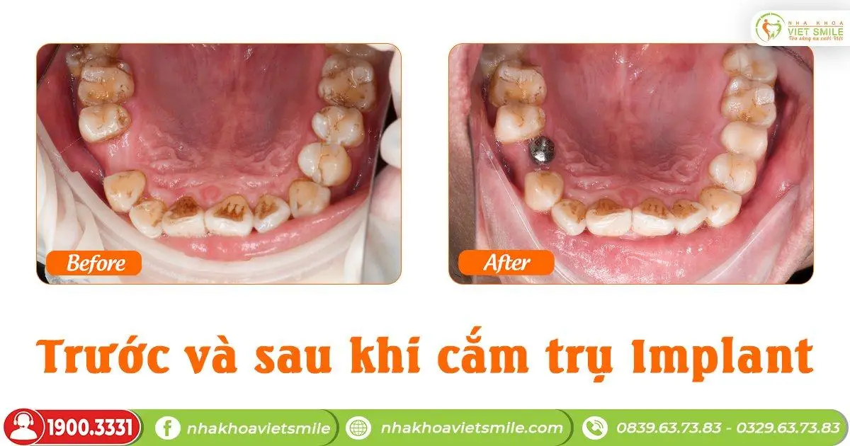 truoc va sau khi cam tru implant