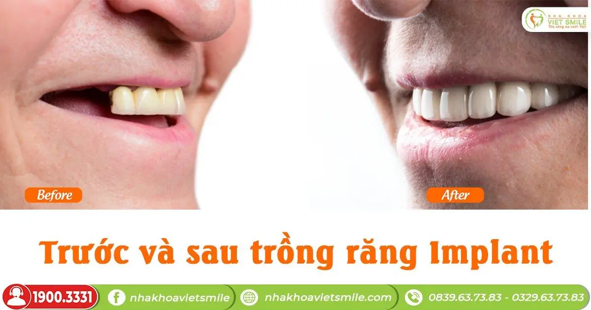 truoc va sau khi trong rang implant