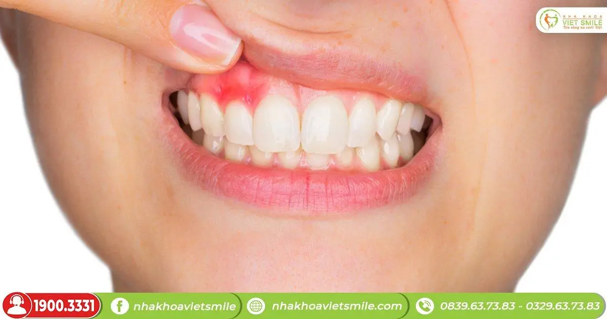 Nguyên nhân gây ra viêm lợi có mủ?