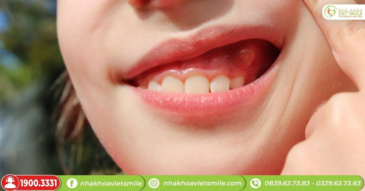 Viêm lợi có mủ trắng biểu hiện như nào?