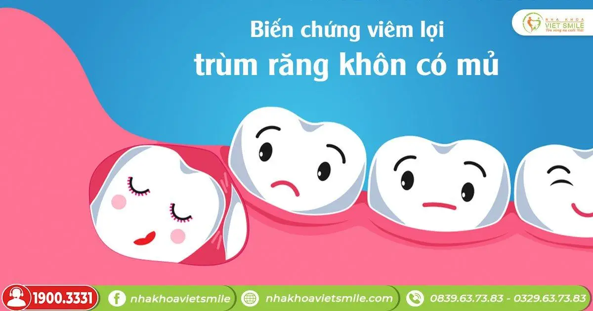 Biến chứng viêm lợi trùm răng khôn có mủ