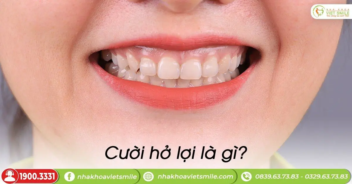 Cười hở lợi là gì