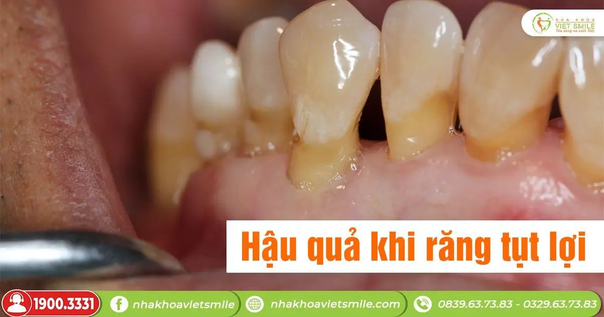 Tụt lợi là gì? Hậu quả khi răng tụt lợi