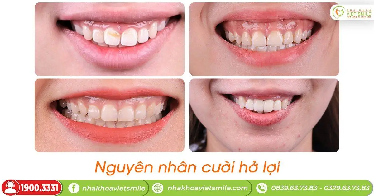 Nguyên nhân cười hở lợi