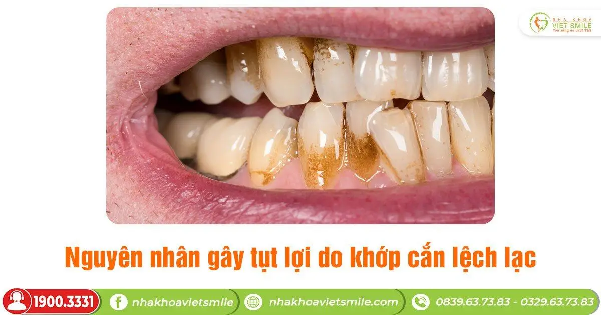 Tụt lợi là gì? Nguyên nhân gây tụt lợi do khớp cắn lệch lạc
