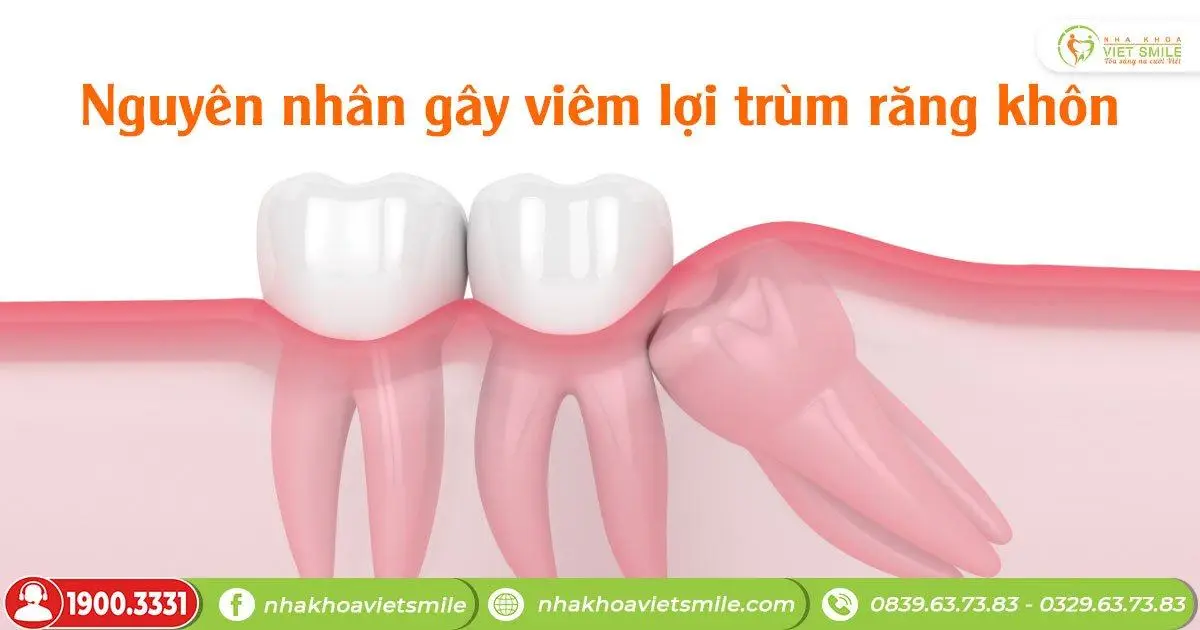 Nguyên nhân gây viêm lợi trùm răng khôn