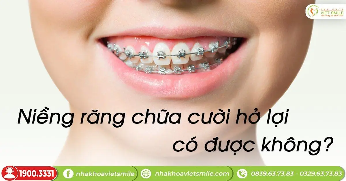 Niềng răng chữa cười hở lợi có được không
