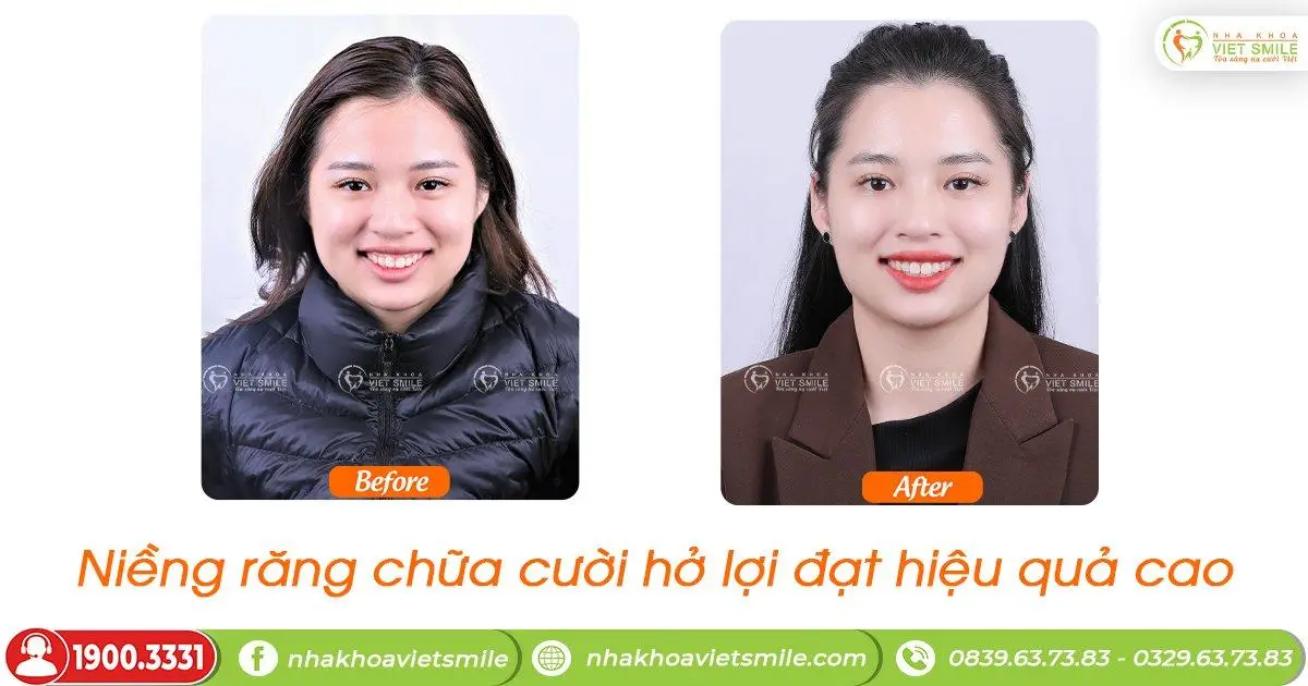 Khách hàng niềng răng chữa cười hở lợi hiệu quả tại Việt Smile