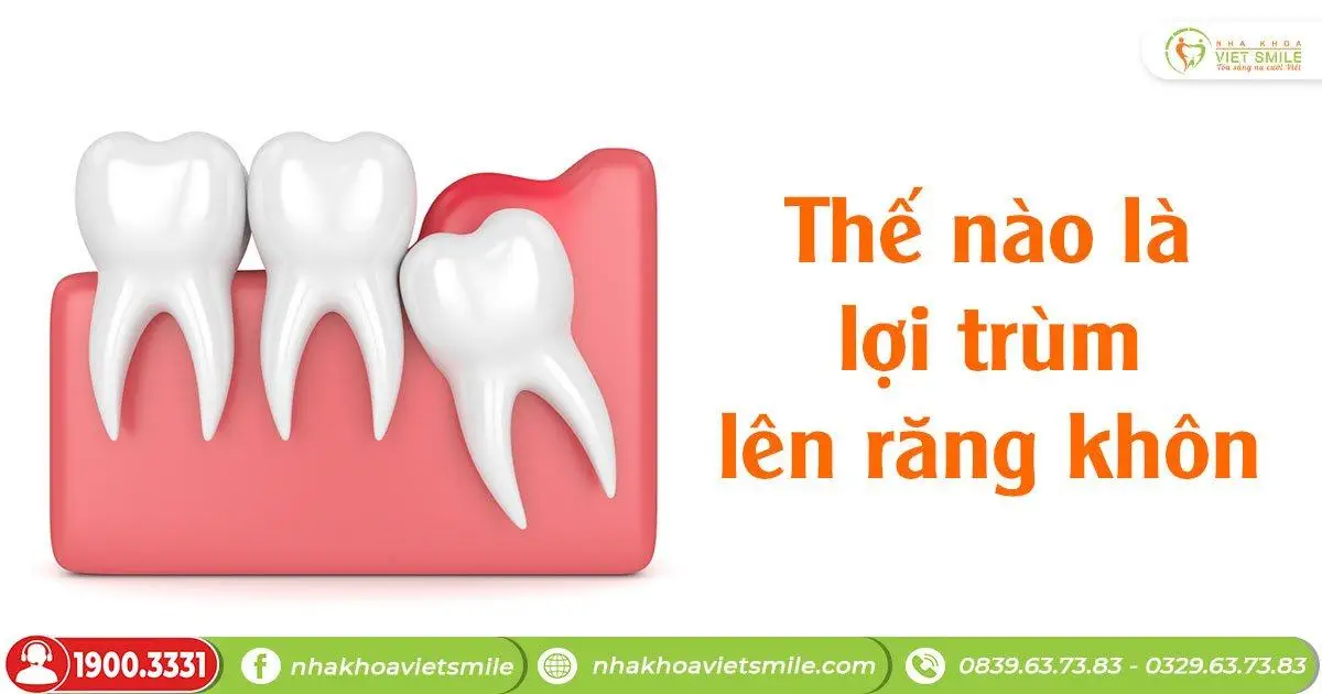 Lợi trùm lên răng khôn