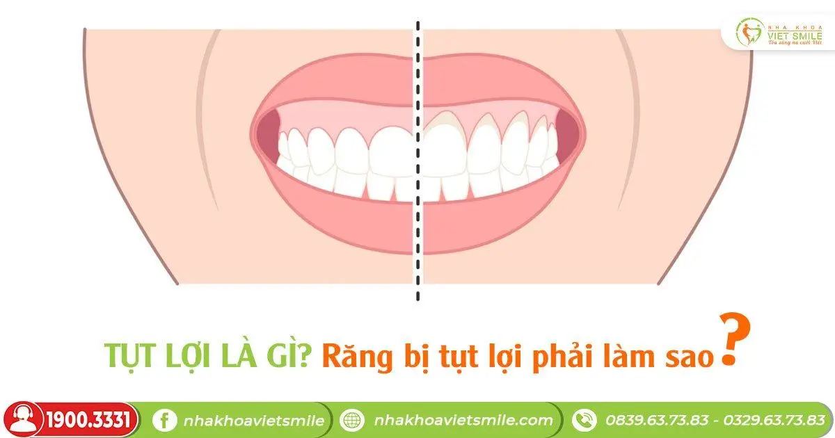 Tụt lợi là gì? Răng bị tụt lợi phải làm sao?