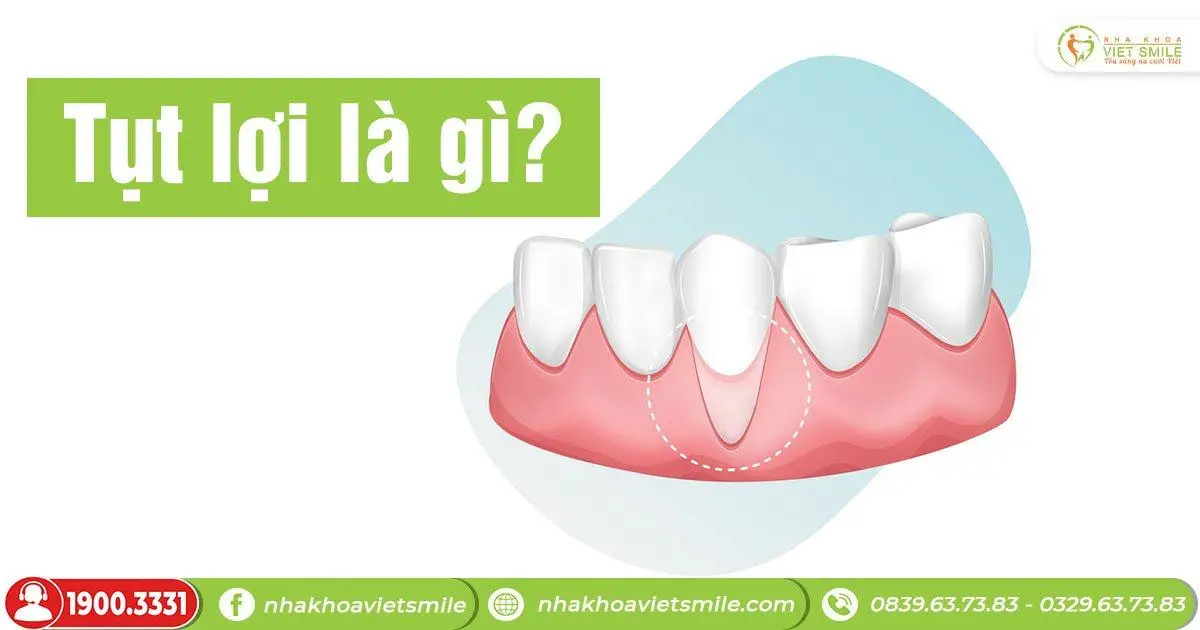 Tụt lợi là gì?