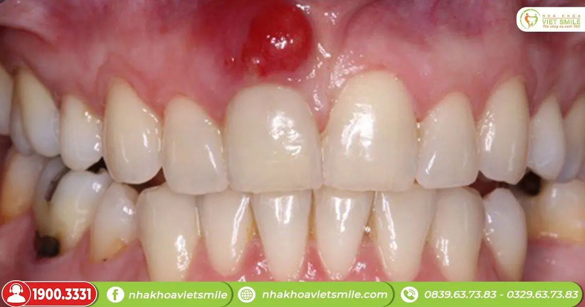 Viêm lợi có mủ là bệnh gì?