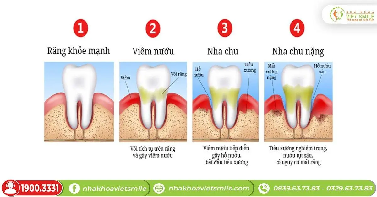 viêm lợi nặng