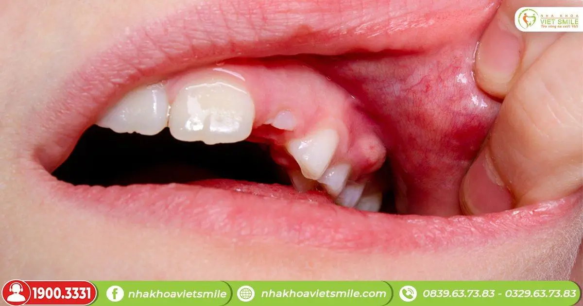 Bị sưng lợi răng hàm