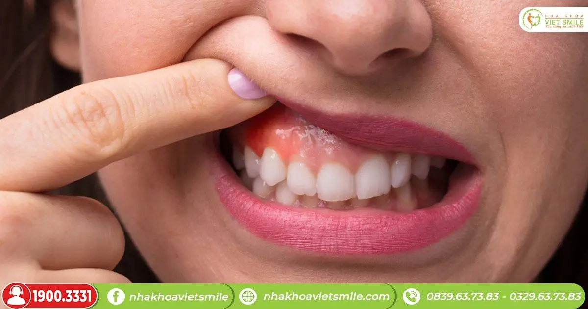Bị sưng lợi hàm trên