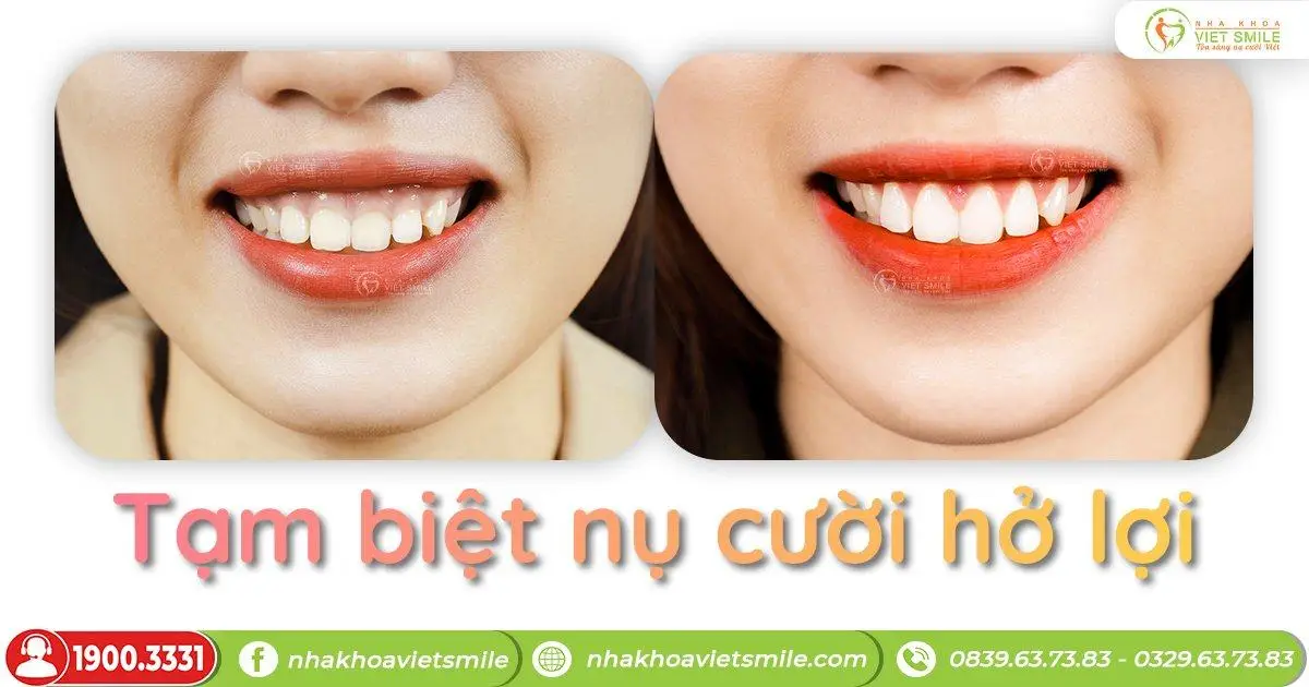 chữa răng ngắn cười hở lợi