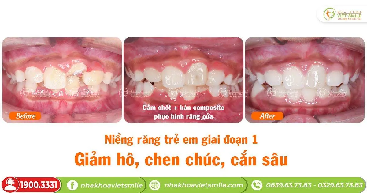 Khớp cắn sâu cần điều trị sớm 
