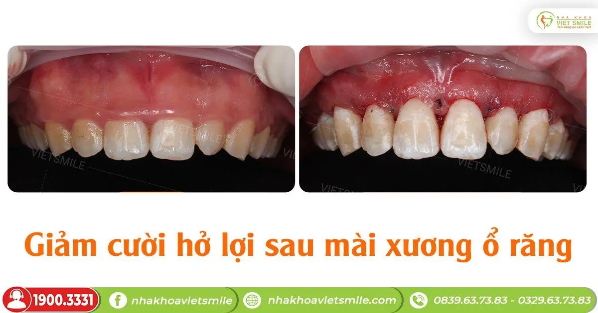 Giảm cười hở lợi sau mài xương ổ răng