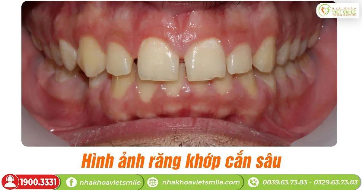  răng bị khớp cắn sâu