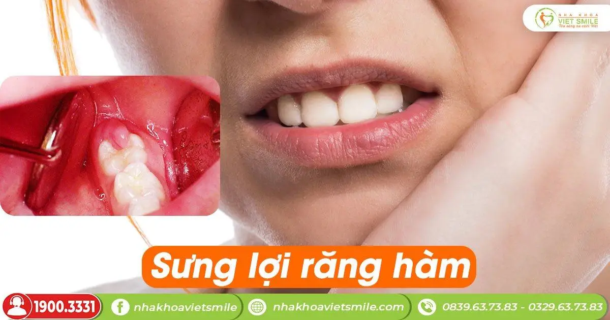 viêm lợi răng hàm