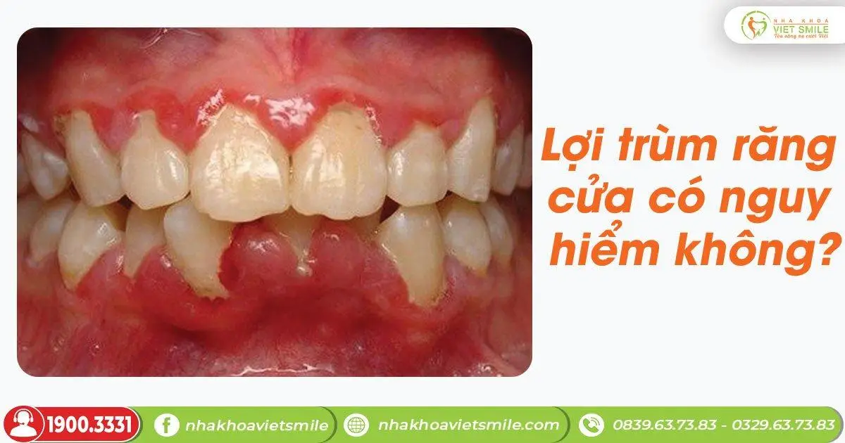 hình ảnh viêm lợi trùm răng cửa
