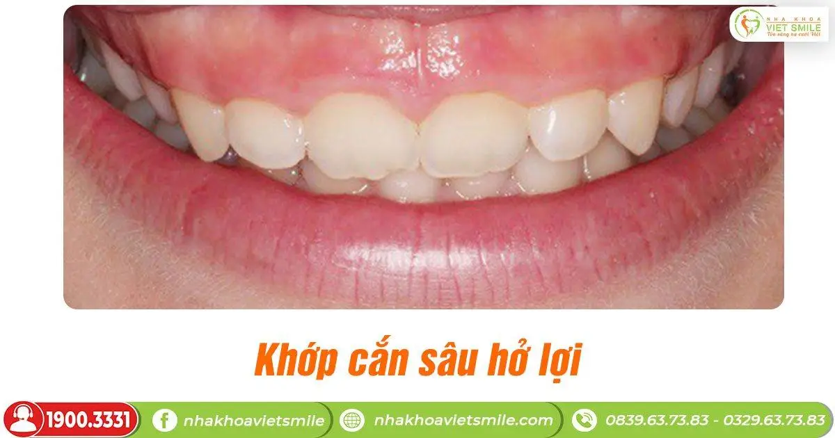 khớp cắn sâu hở lợi
